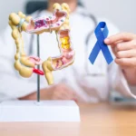 Gejala Kanker Usus yang Sering Dianggap Sepele dan Perlu Diwaspadai