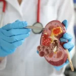 Kanker Ginjal, Penyakit Mematikan yang Sering Datang Tanpa Gejala Jelas