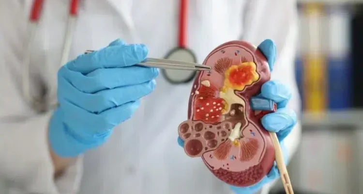 Kanker Ginjal, Penyakit Mematikan yang Sering Datang Tanpa Gejala Jelas